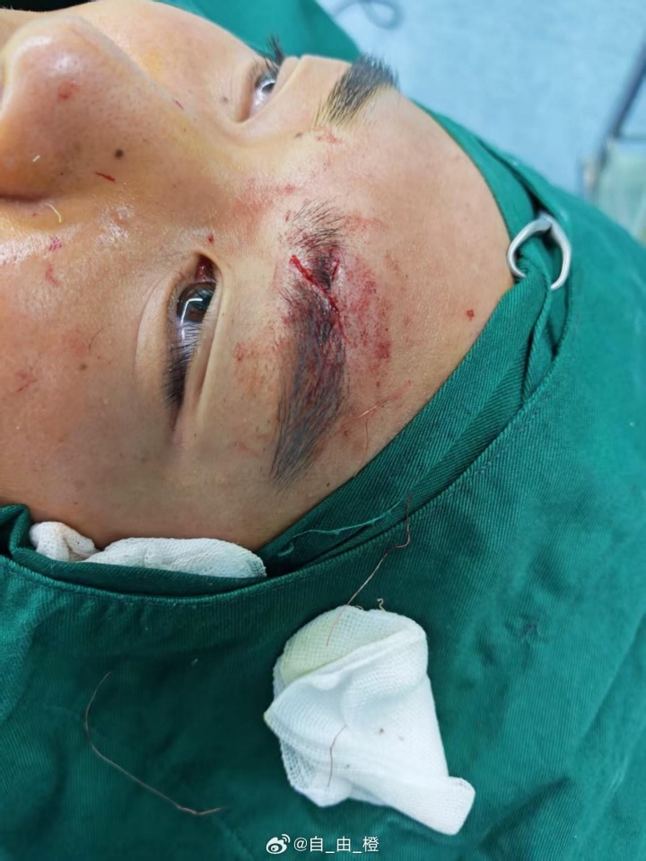 10分钟两次被干下场，泰山小将彭逸翔晒伤口：吃了一肘