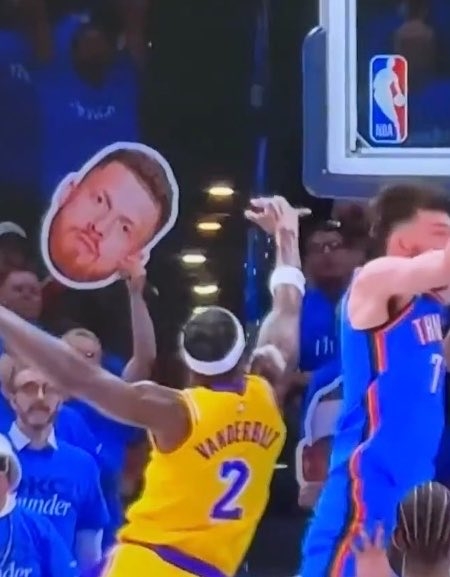 范德比尔特右手小指完全脱臼 骨头刺穿皮肤 康复周期3-6个月